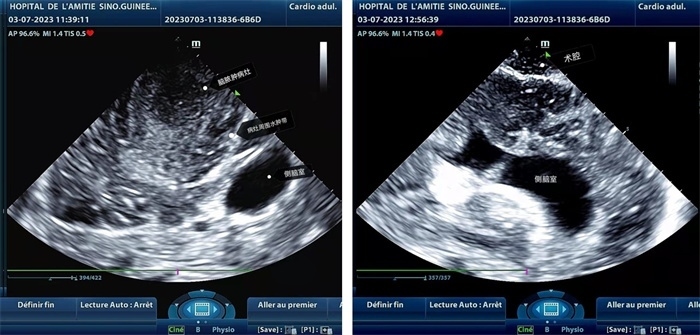 左圖顯示術(shù)中超聲見(jiàn)囊實(shí)性病變，大小約為4x4x3cm，病灶周圍腦組織水腫明顯；右圖為病灶切除后，術(shù)中超聲示術(shù)腔無(wú)病變殘留
