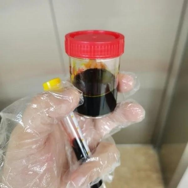 急性肝衰竭！兩兄弟誤吃這種菌 專家提醒