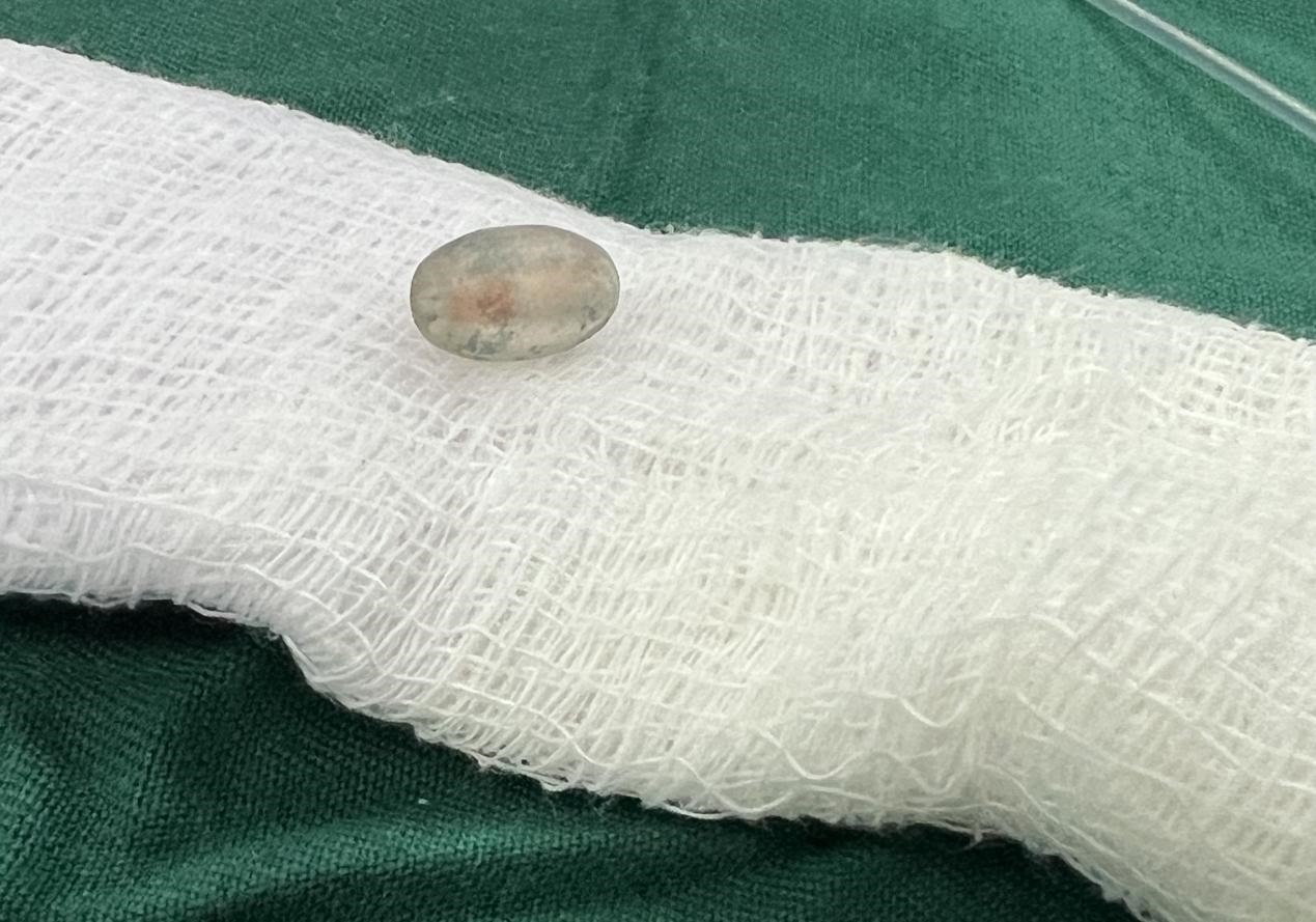 被取出的異物。中國援桑醫(yī)療隊(duì)供圖